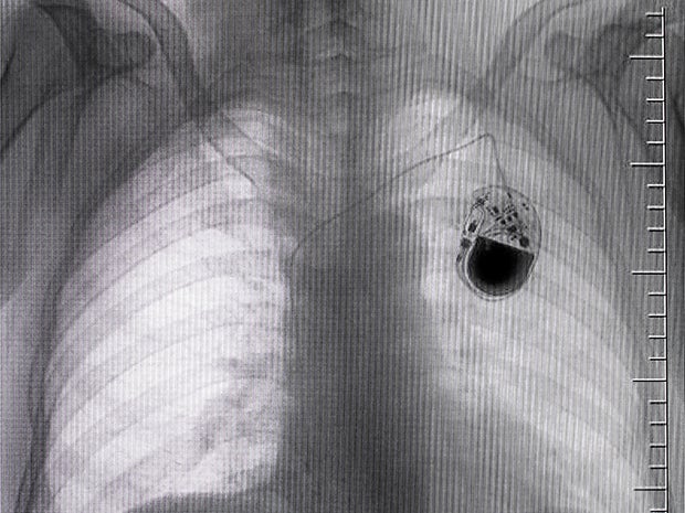 pacemaker xray